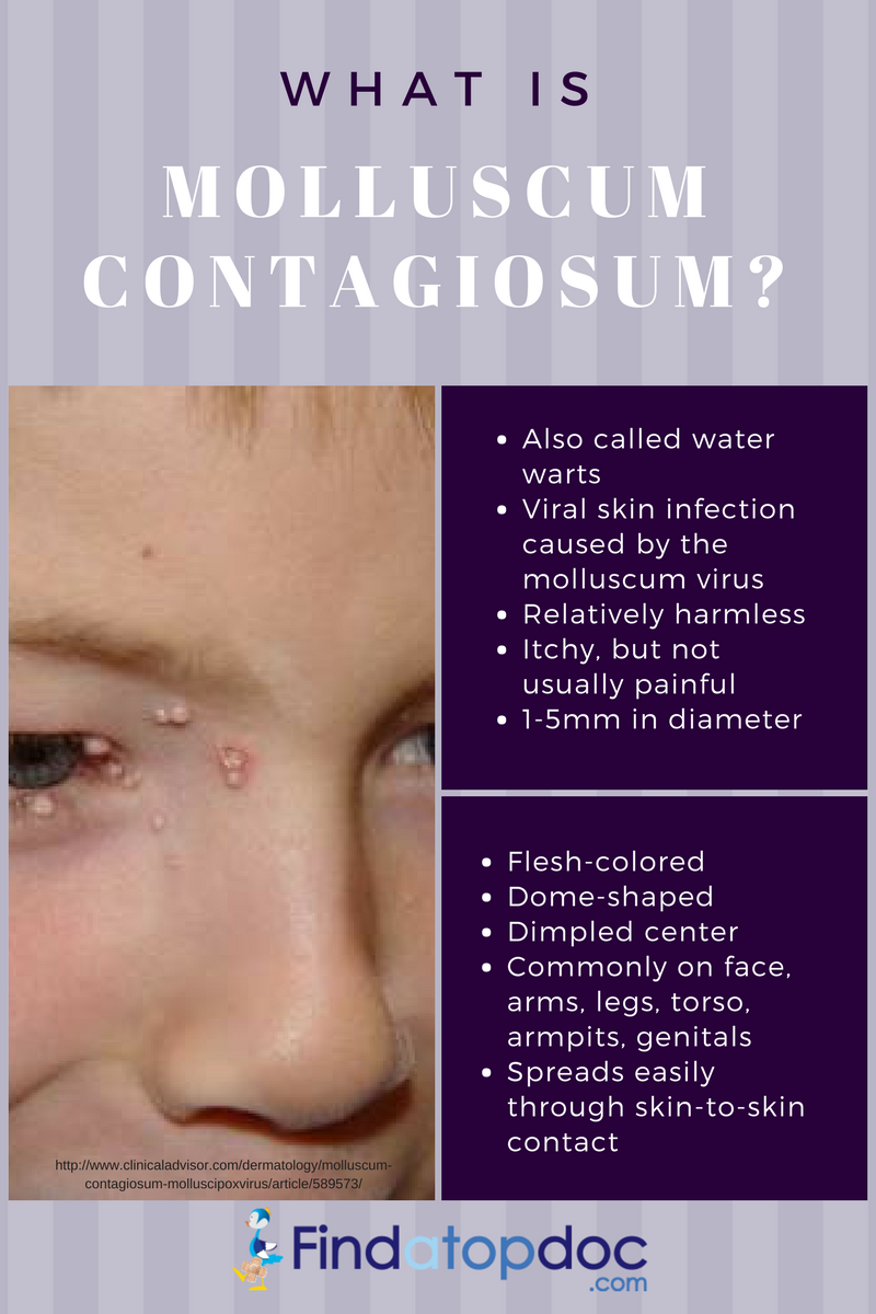 Symptoms Causes And Treatments Molluscum Contagiosum Facty Health Sexiz Pix