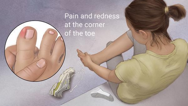 Ingrown Nails (Onychocryptosis, Ingrown toenails) - Dermatology Advisor
