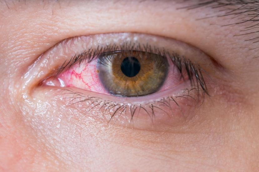 How To Get Rid Of Dry Itchy Red Eyes