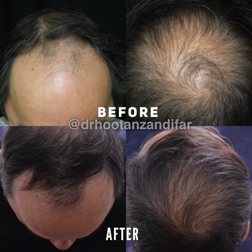 Dallas Finasteride and Minoxidil Before and After Photos  Plano Plastic  Surgery Photo Gallery  Dr Samuel LamFinasteride and Minoxidil Archives   Lam Sam hairtxcom