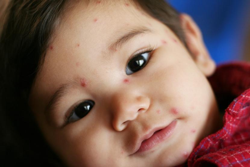 Chickenpox Important Facts, Causes and Home Remedies