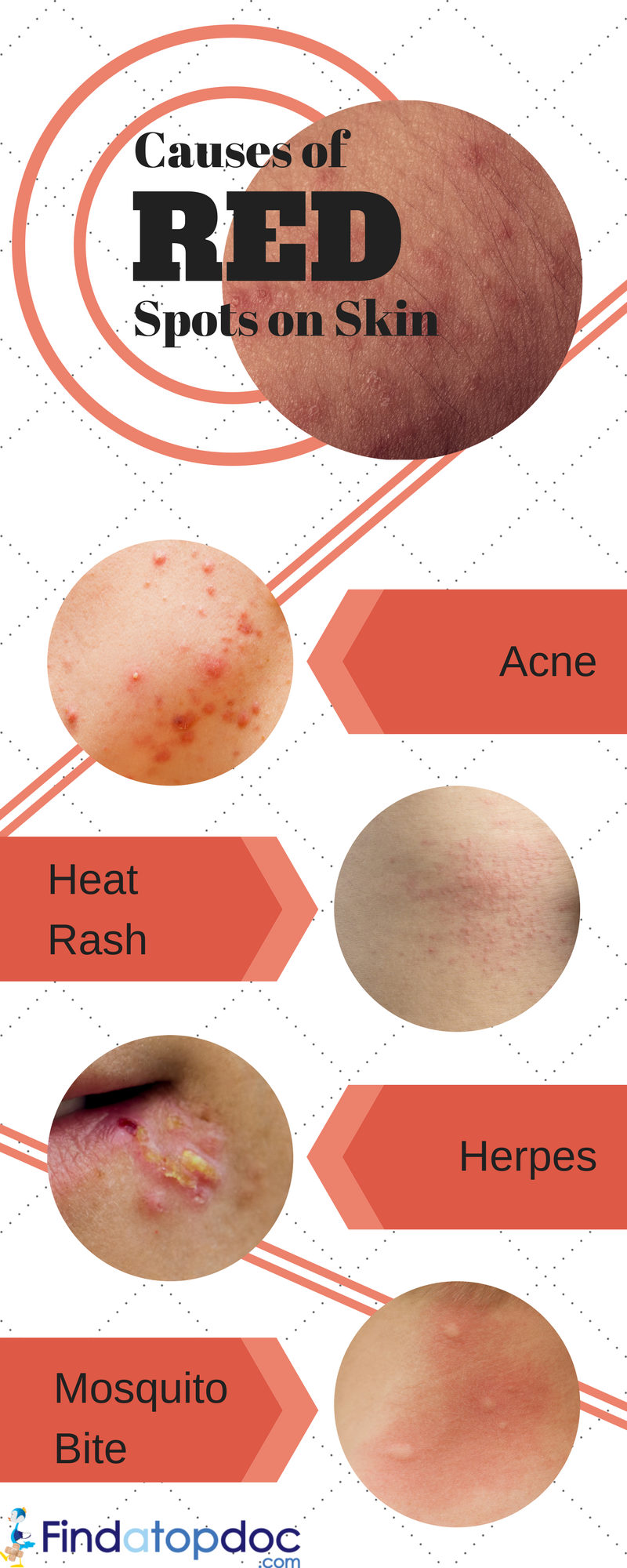 Heat Rash: Signs, Duration, and Treatment