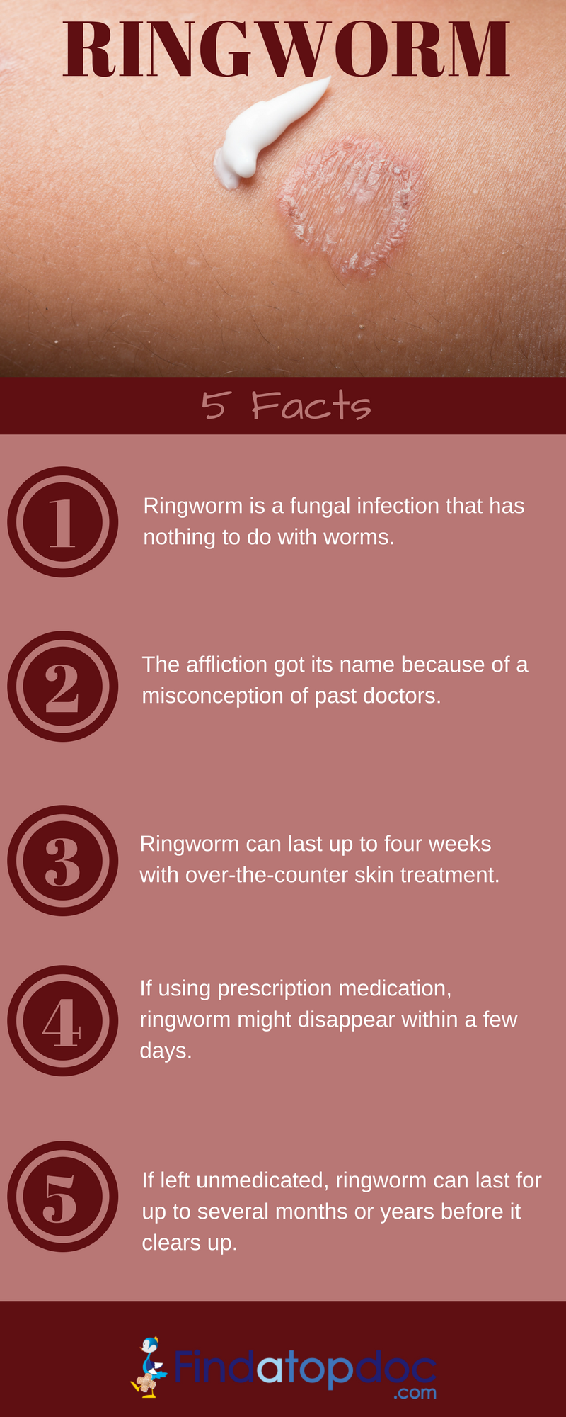 Home remedies for ringworm – Artofit