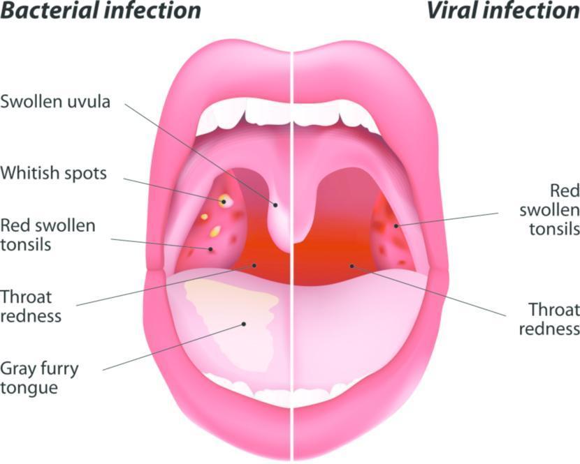 Sore Throat Types Causes Symptoms And Treatments - vrogue.co
