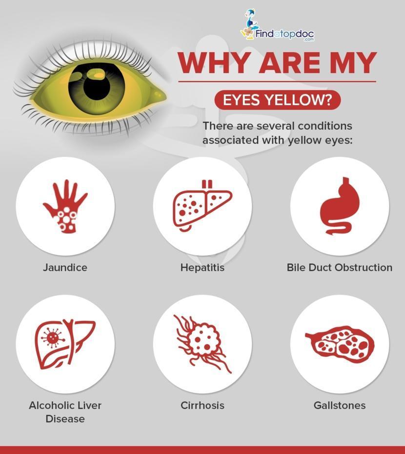 causes of jaundice eyes