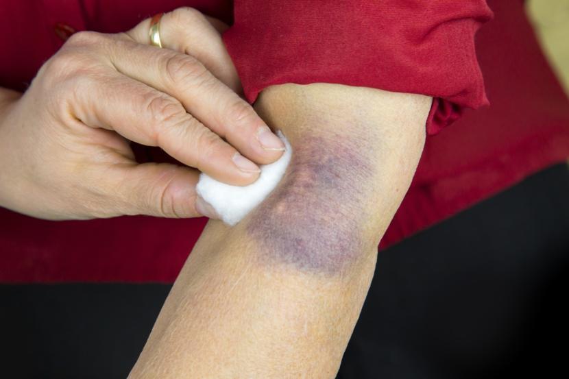 Bruises on dark skin: Symptoms and treatment