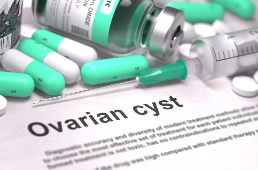 What Every Woman Should Know About Ovarian Cysts 