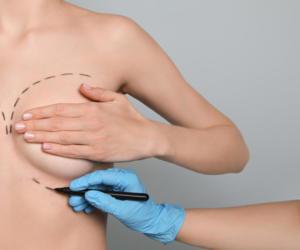 Dr. Alexander & Co. - Breast augmentation done with silicone gel