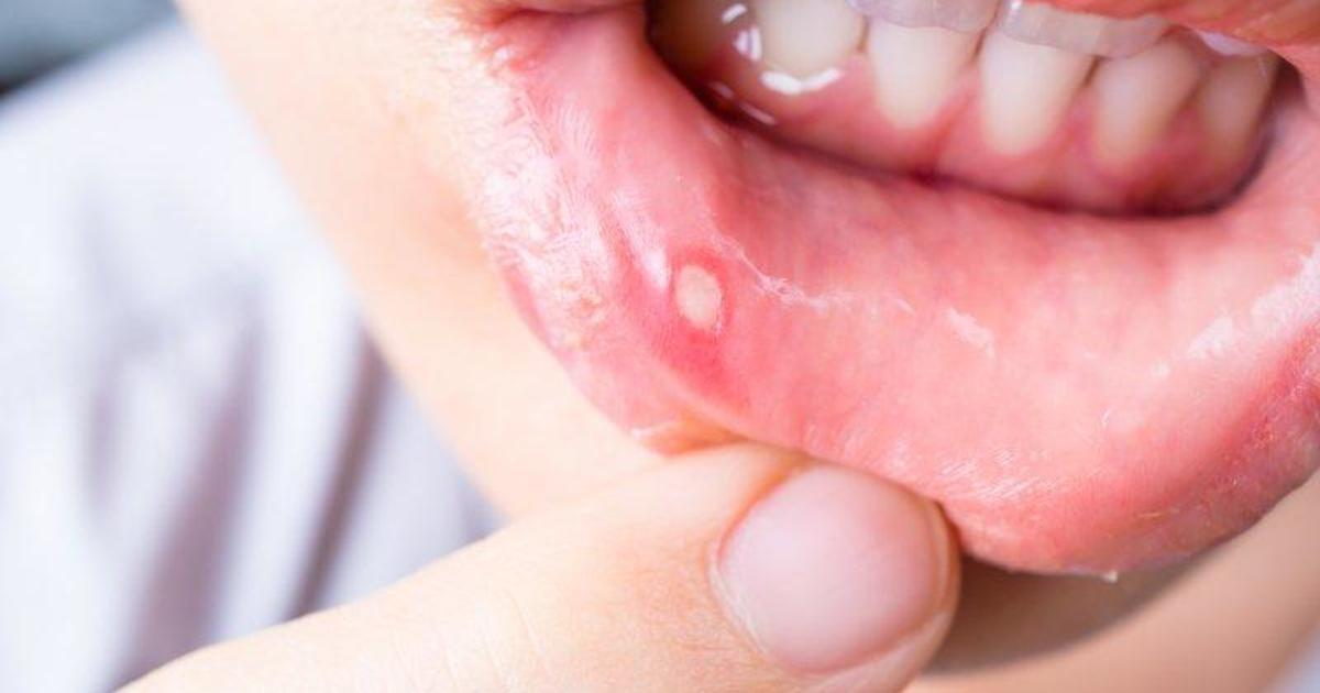 White Bump On Inside Of Lip Causes Symptoms And Remedies
