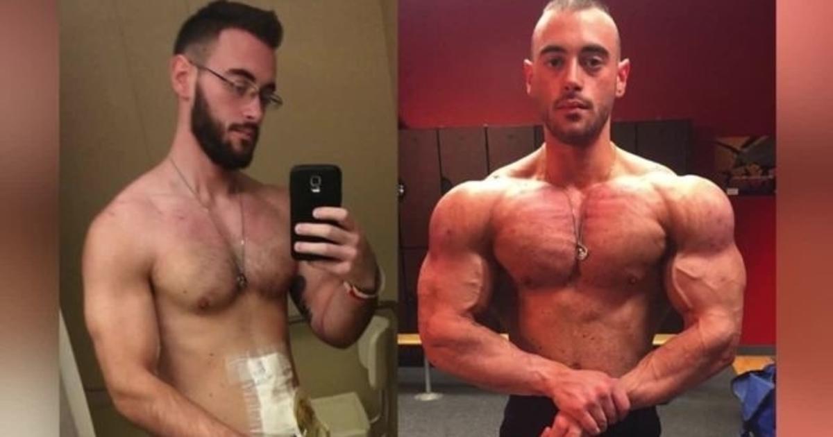 Inspiring Others with Crohn's Disease through Bodybuilding