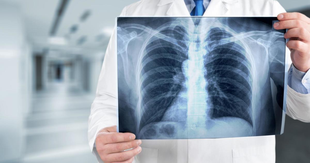 Removal of the lungs meant removal of the infection | FindATopDoc