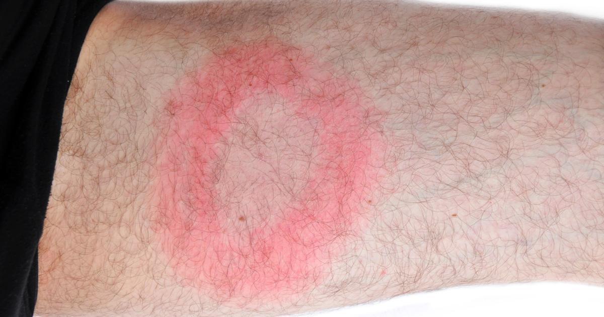 What Happens If Lyme Disease Goes Untreated