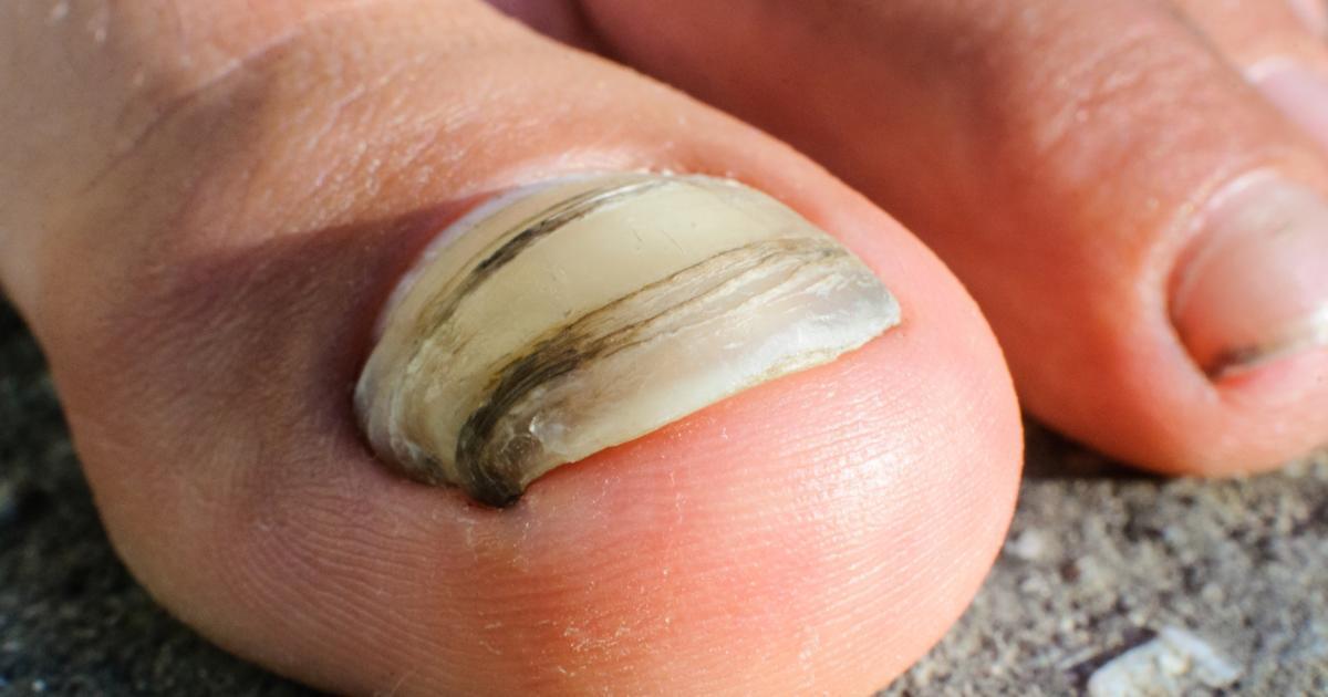 Podiatry Care Specialists - Did you know that half of all nail diseases are  caused by fungi? Fungi sneak beneath your nail beds and can cause the  toenails to become dark, brittle,