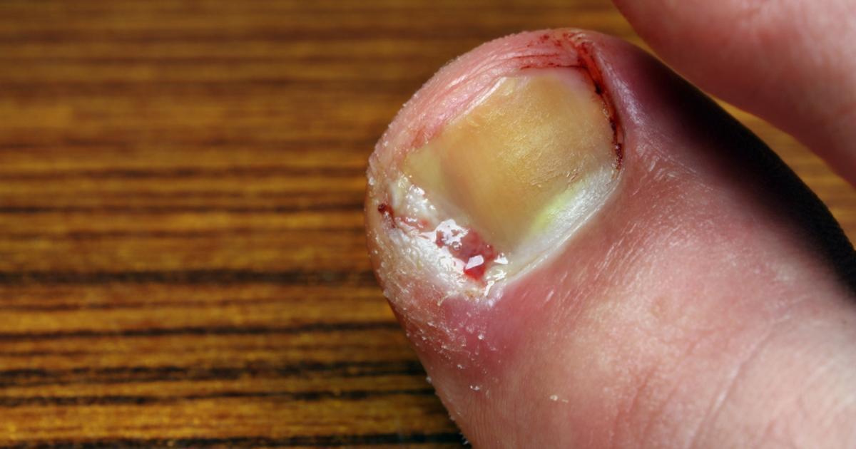 What Does A Bad Ingrown Toenail Look Like