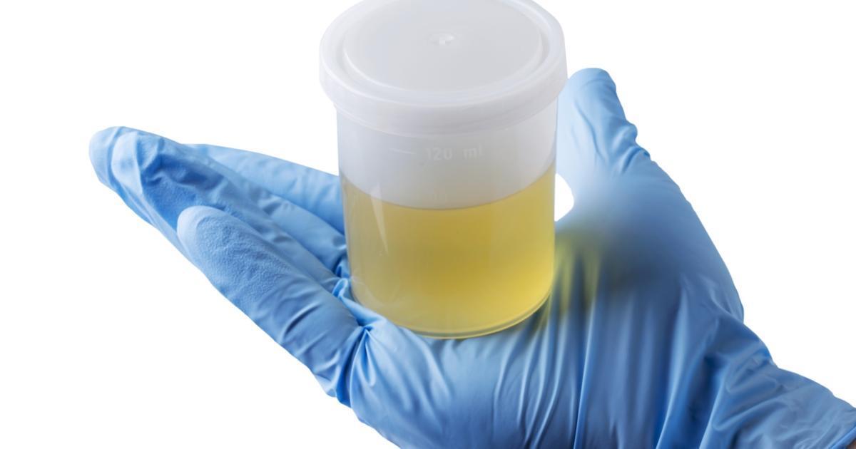 What does cloudy urine mean?