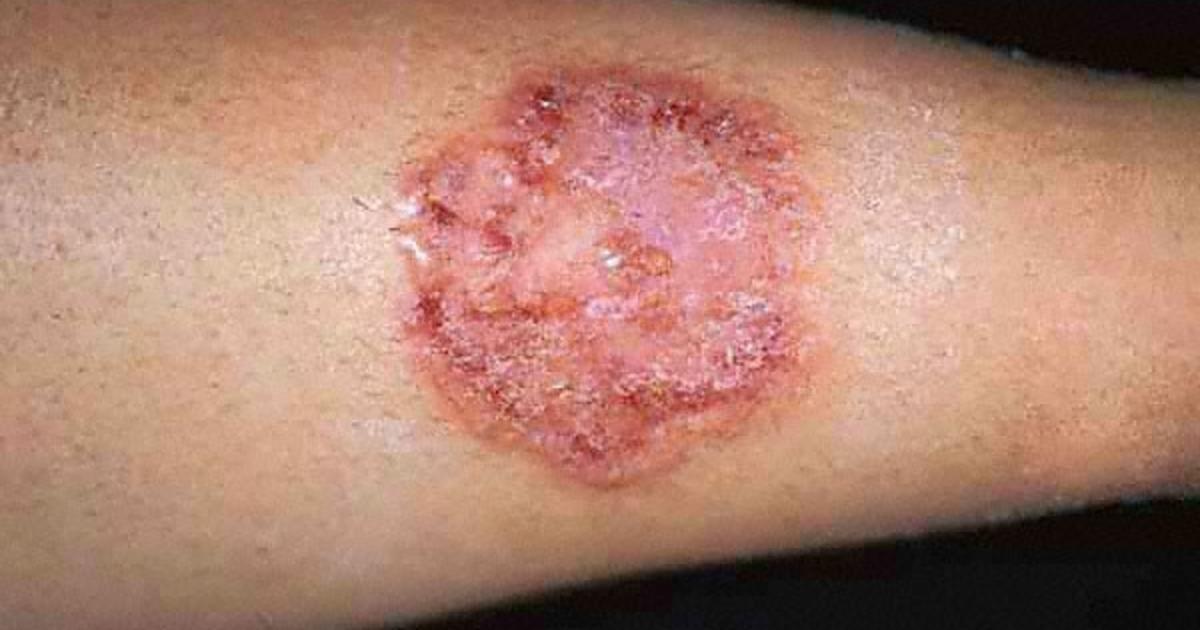 early ringworm in humans