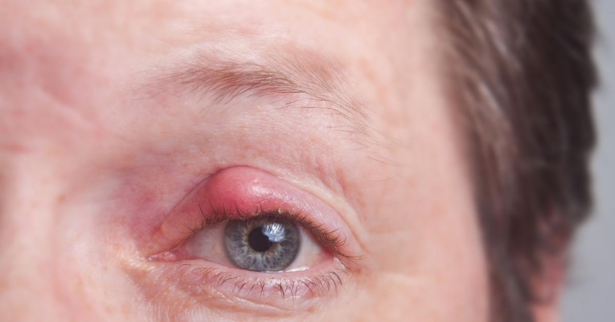 What Is Eye Herpes Symptoms Treatment Complications