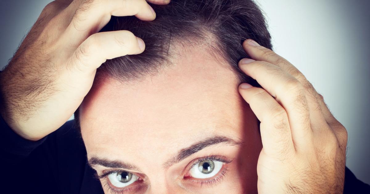 scalp psoriasis hair loss