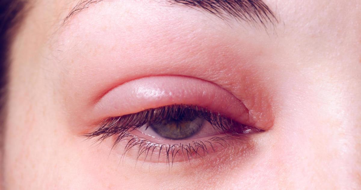 What Could A Swollen Eyelid Mean 