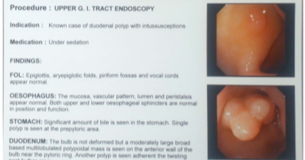 hx of duodenal polyp icd 10