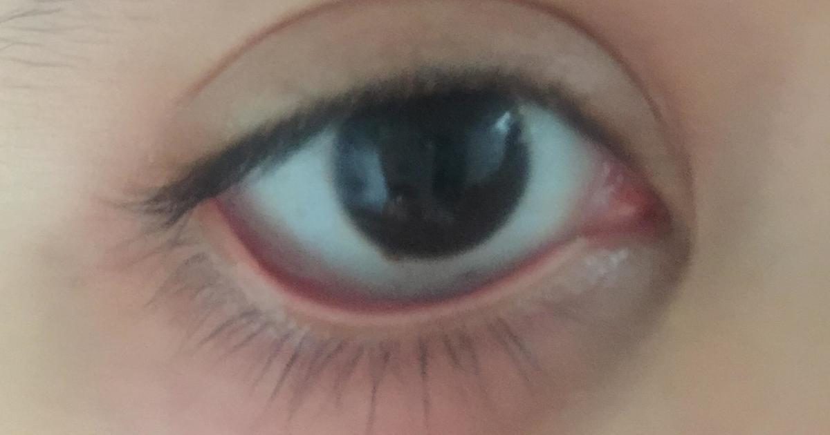 Eye problems?