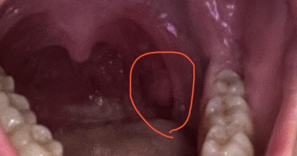 Surgery To Remove Mass From Throat