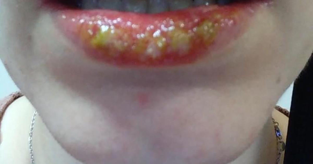 lip-allergic-reaction