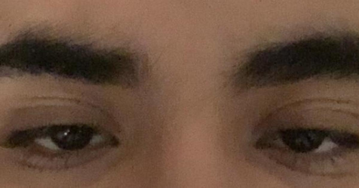 Signs of bulging eyes?