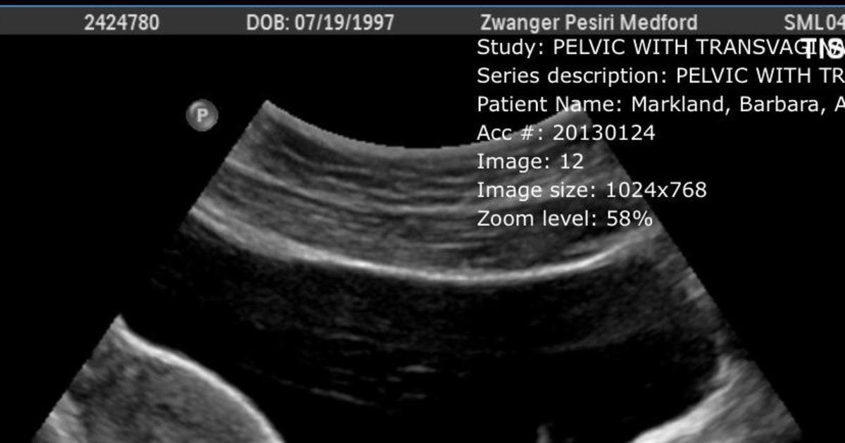 Ultrasound interpretation?