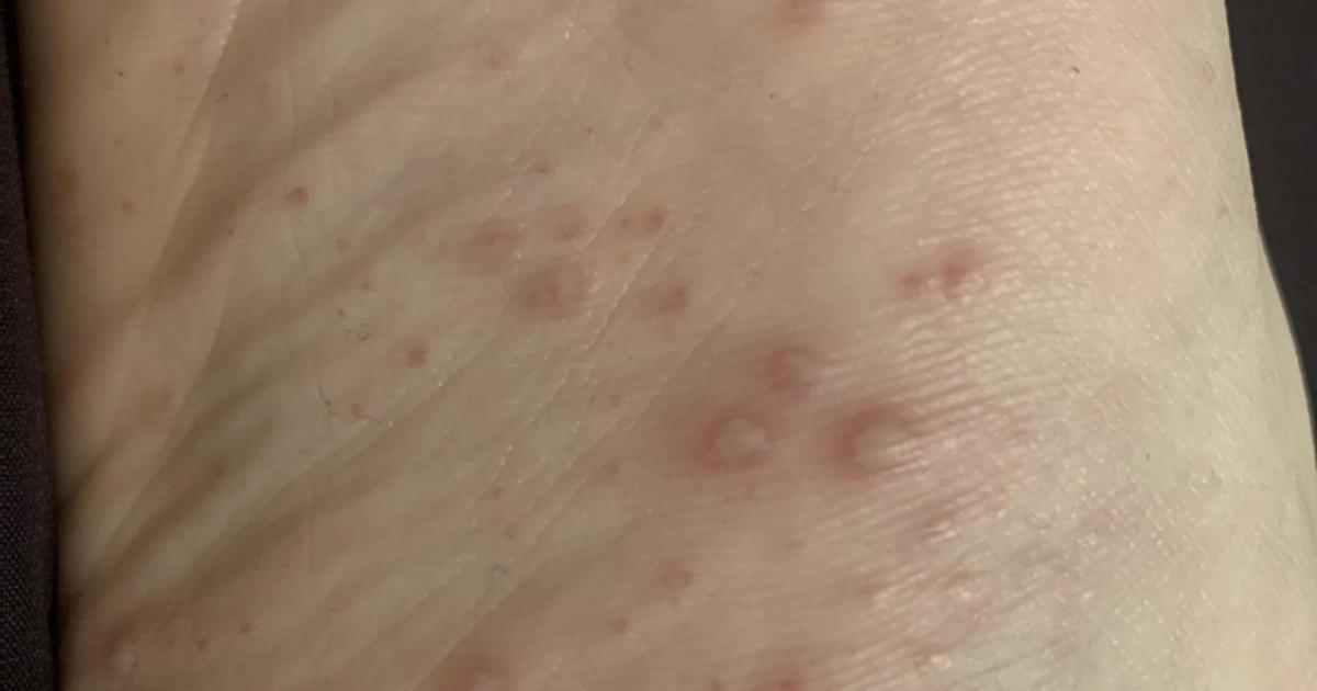 Small Red Bumps On Feet