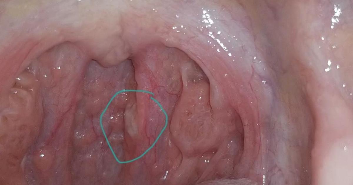 White Lump Behind Tonsils