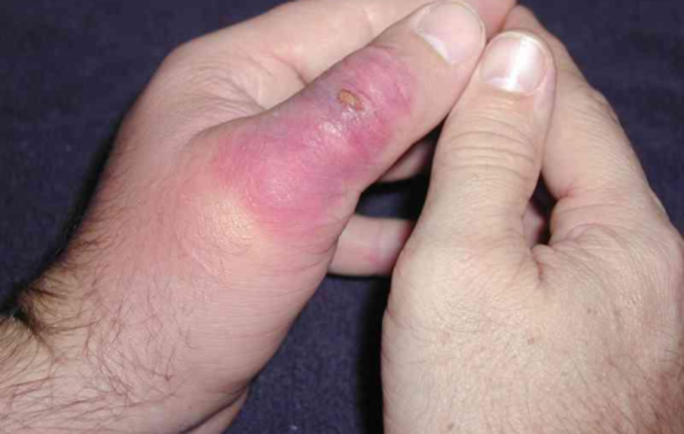 Spider Bite Pictures - What They Look Like, How To Treat Symptoms