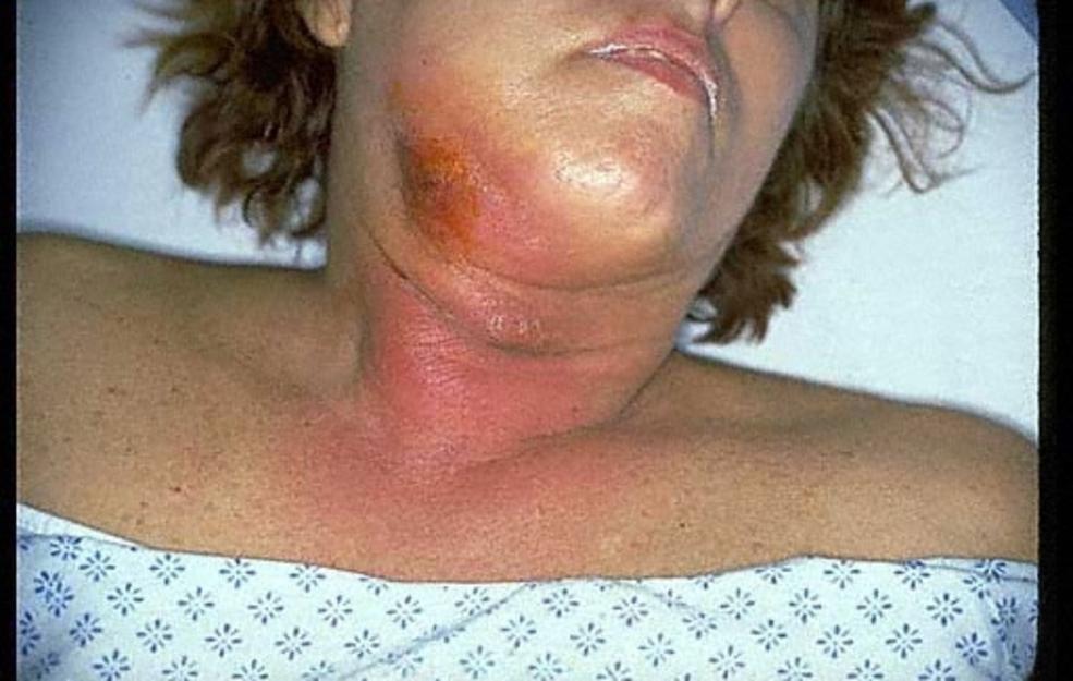 cellulitis neck
