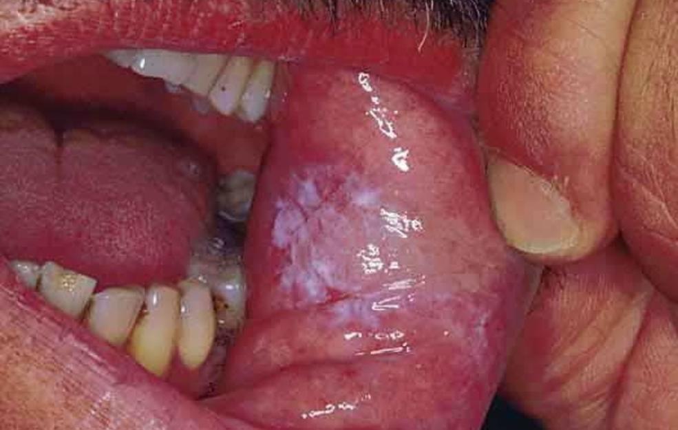 thrush from antibiotics in mouth