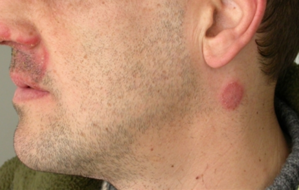 What are the Symptoms of Ringworm?