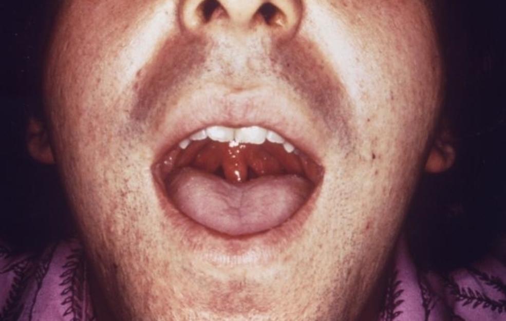 what does chlamydia look like in the mouth