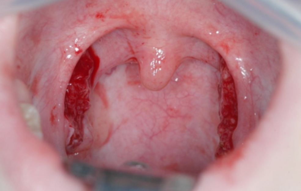 red spots on tonsils