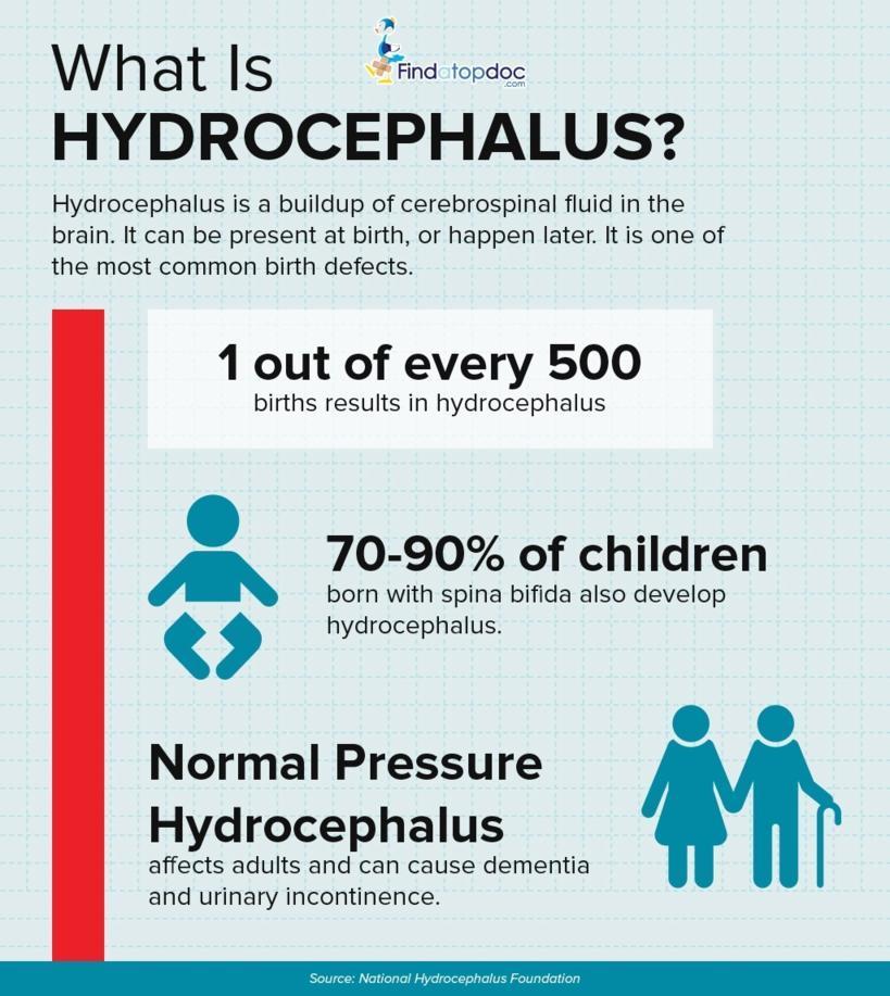 Infographic What Is Hydrocephalus 7435