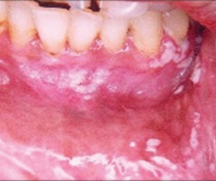 Candida esophagitis as related to Sore Throat - Pictures