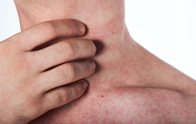Symptoms of Mono Rash Infectious Mononucleosis Causes, Treatment