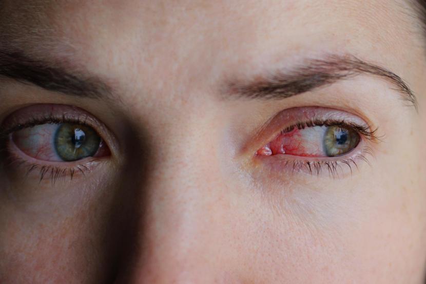 Pink Eye Vs Allergies Causes Symptoms And Treatment 