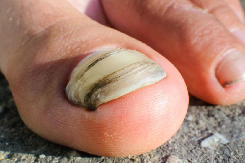 what-are-the-causes-and-symptoms-of-nail-fungus