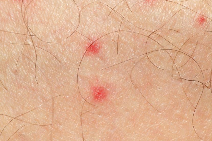 tiny pinpoint red dots on skin caused by viruses