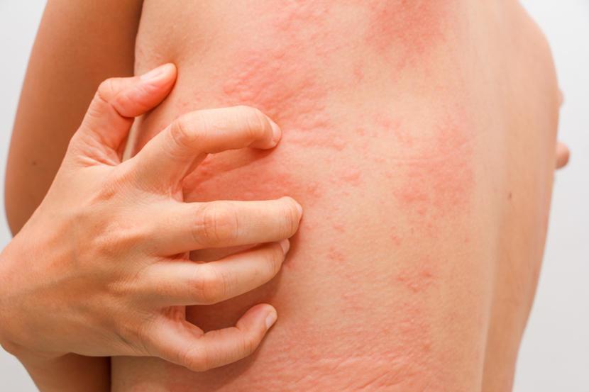 what-is-chronic-urticaria