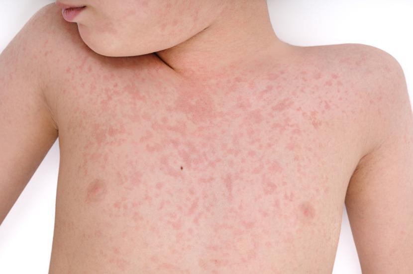 german-measles-rubella-causes-symptoms-treatments-and-home-remedies